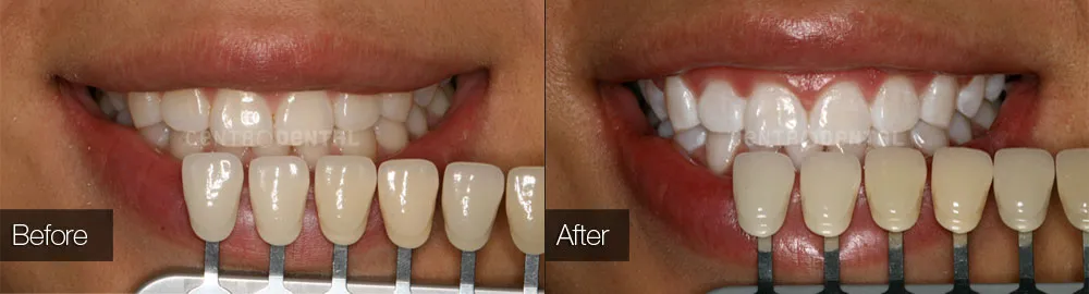 26947 zoom whitening blotchy teeth 4