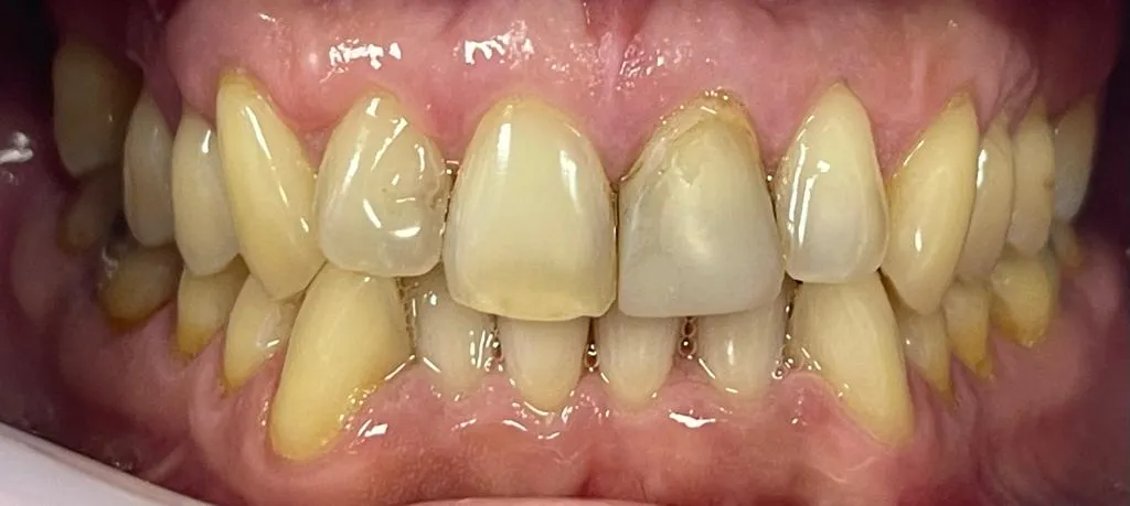 26947 zoom whitening blotchy teeth 5