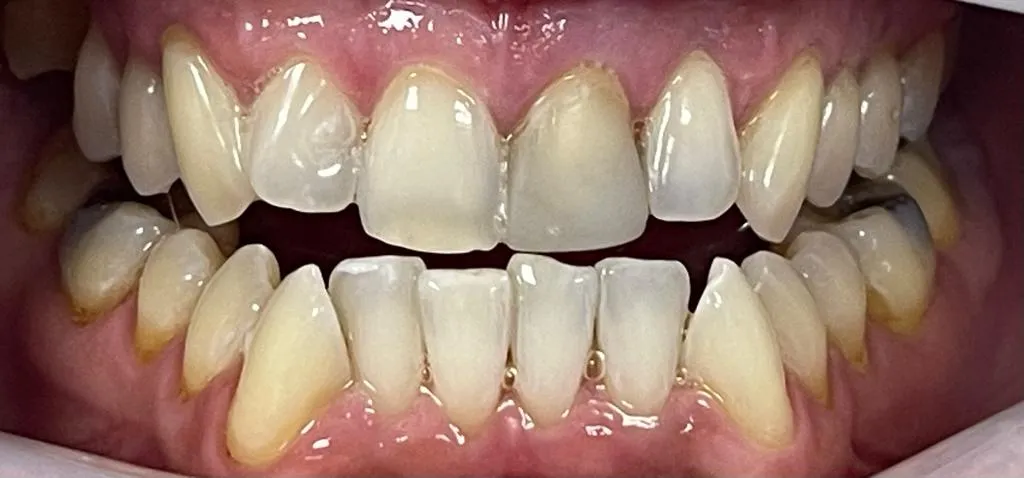 26947 zoom whitening blotchy teeth 6