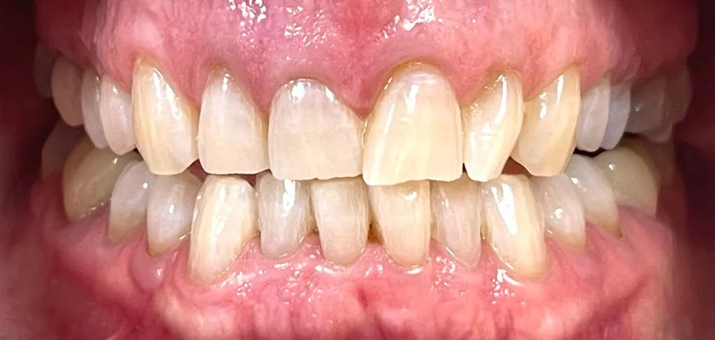 26947 zoom whitening blotchy teeth 7