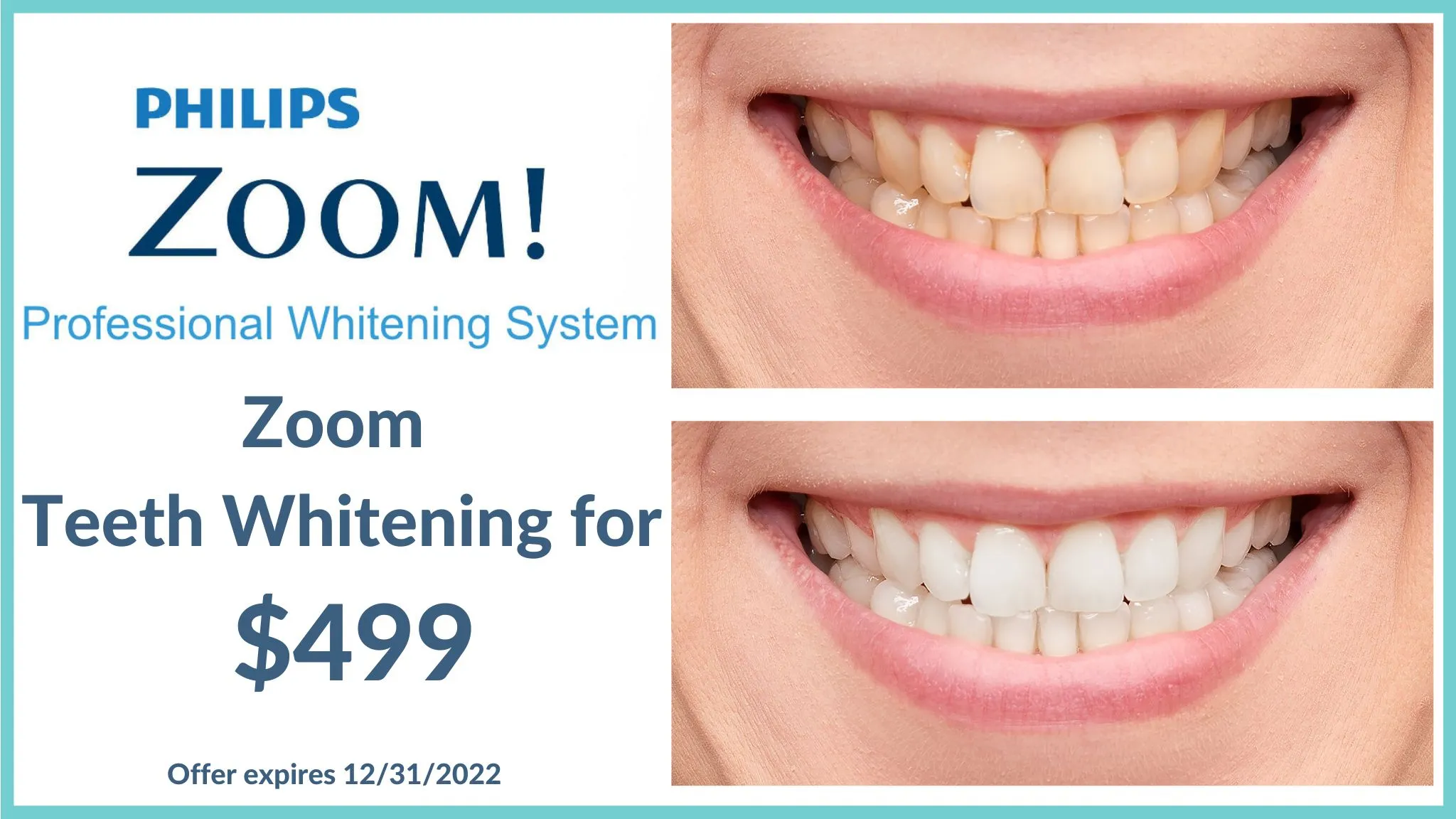 /img/26947-zoom-whitening-blotchy-teeth-8.webp