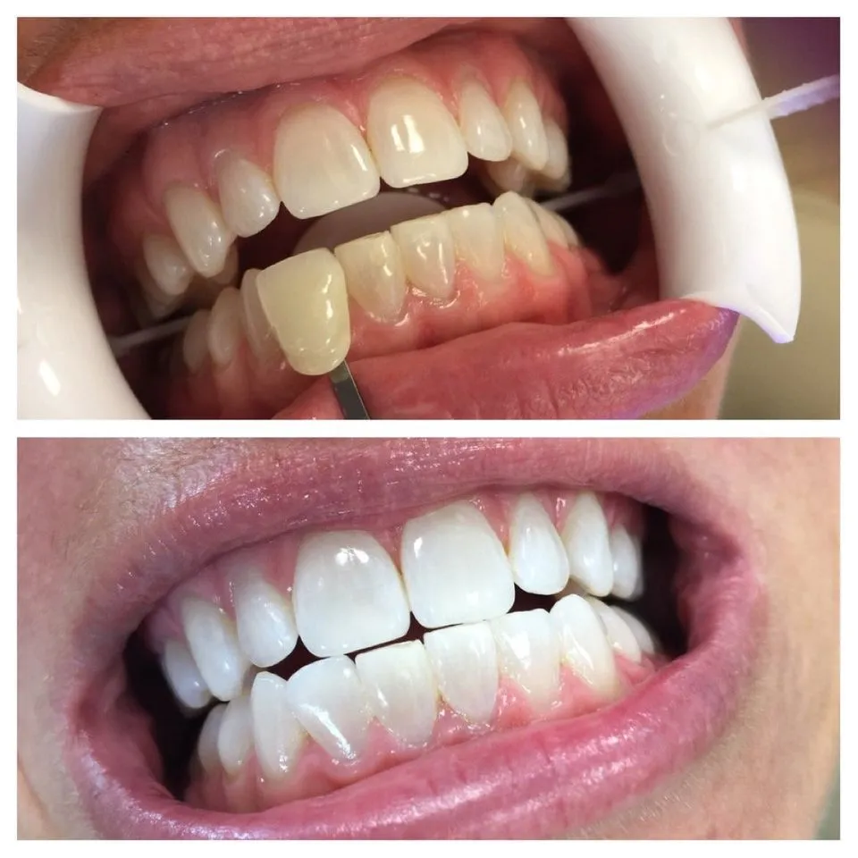 /img/26948-teeth-whitening-agents.webp