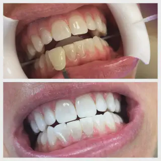 /img/26948-teeth-whitening-agents.webp