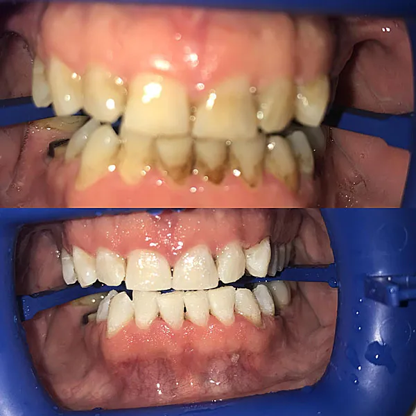 26956 zoom whitening alternatives