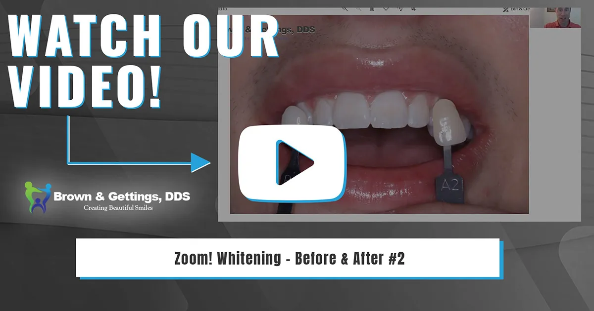 26956 zoom whitening before after smile