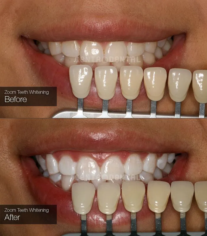 /img/26956-zoom-whitening-dentist-appointment.webp