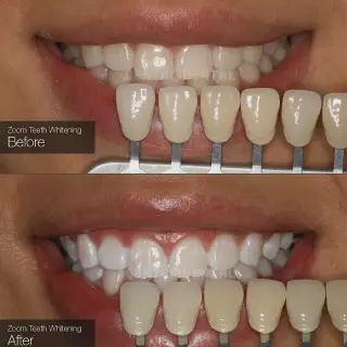 /img/26956-zoom-whitening-dentist-appointment.webp