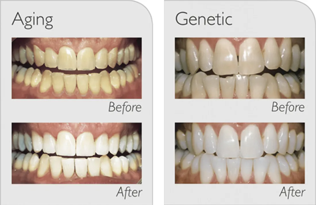26956 zoom whitening lifestyle
