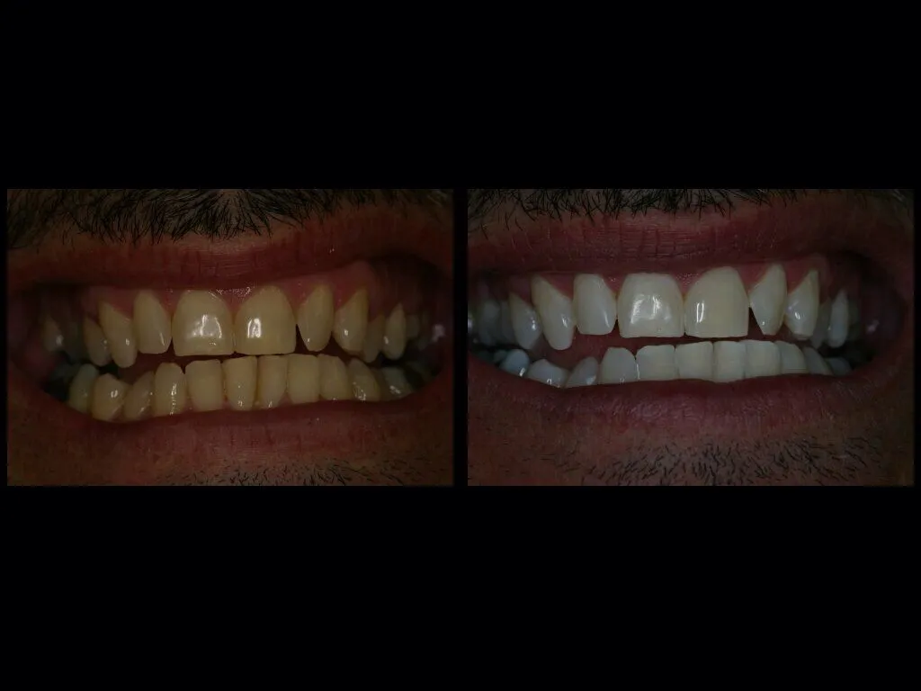 26956 zoom whitening oral hygiene