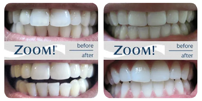 26956 zoom whitening procedure