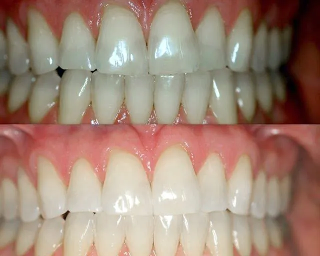 26956 zoom whitening results