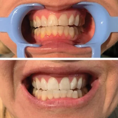26963 dr davey teeth whitening long lasting