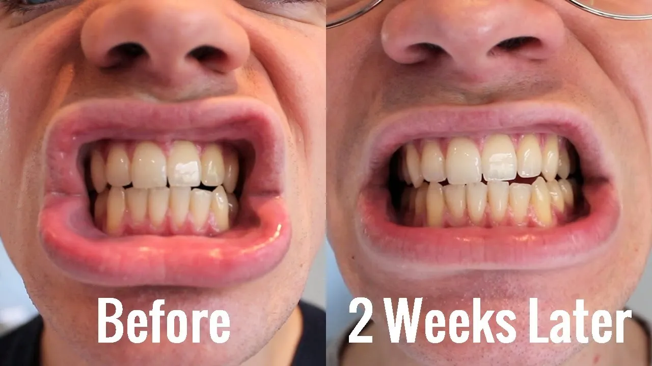 26963 dr davey teeth whitening quick results