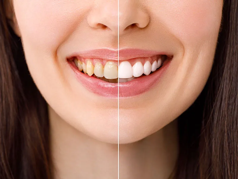 26965 at home whitening kits