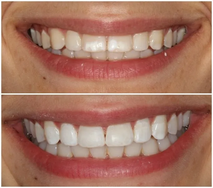 26967 teeth whitening cost missoula