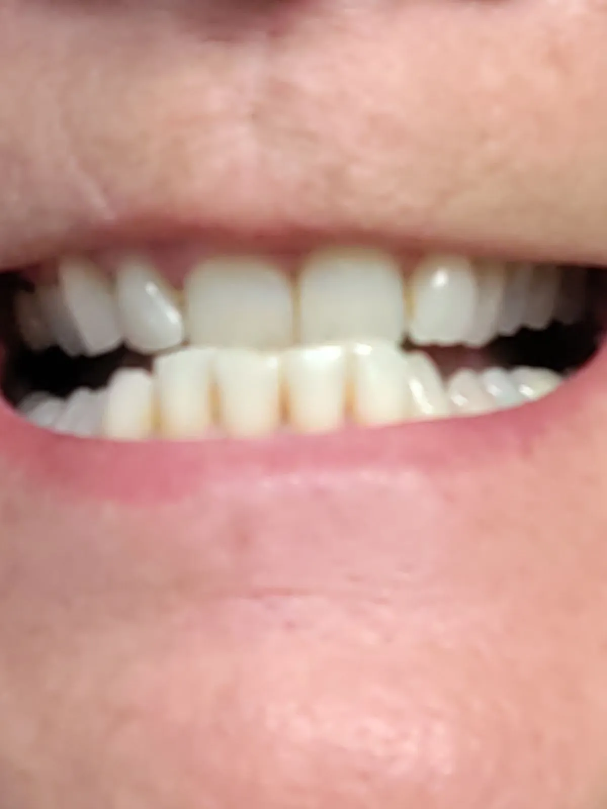 /img/26969-realistic-whitening-expectations.webp