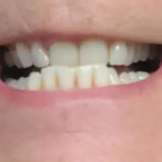 /img/26969-realistic-whitening-expectations.webp
