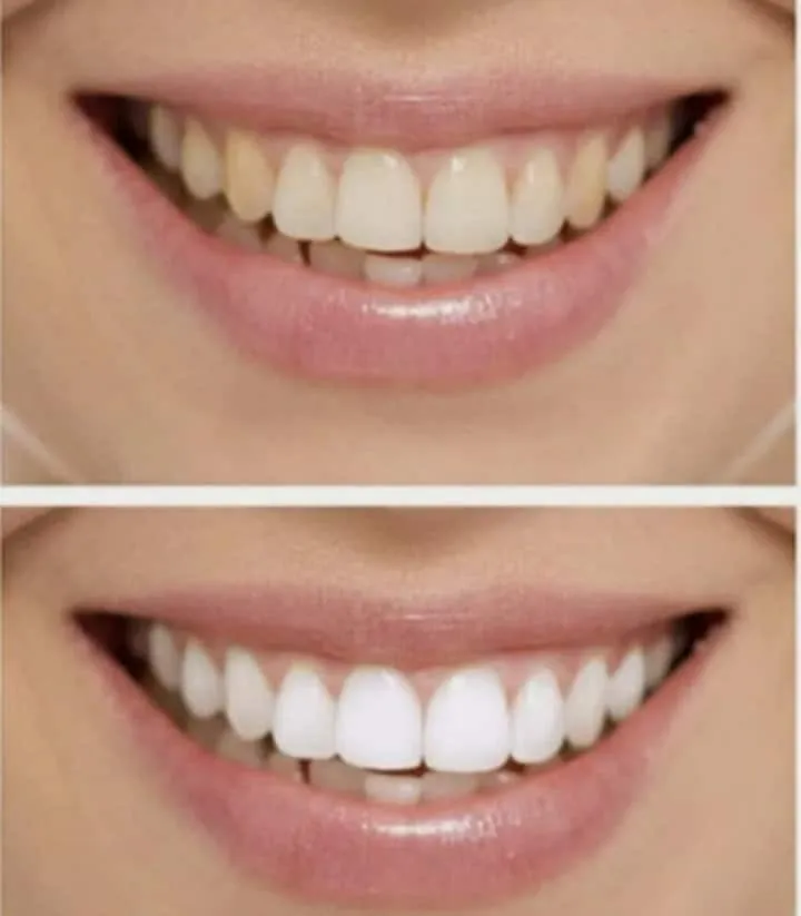 26969 teeth whitening alternatives