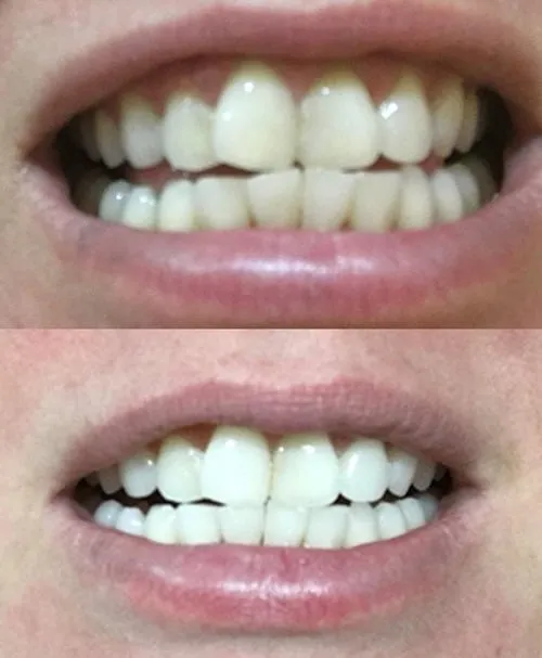 26972 fda approved whitening
