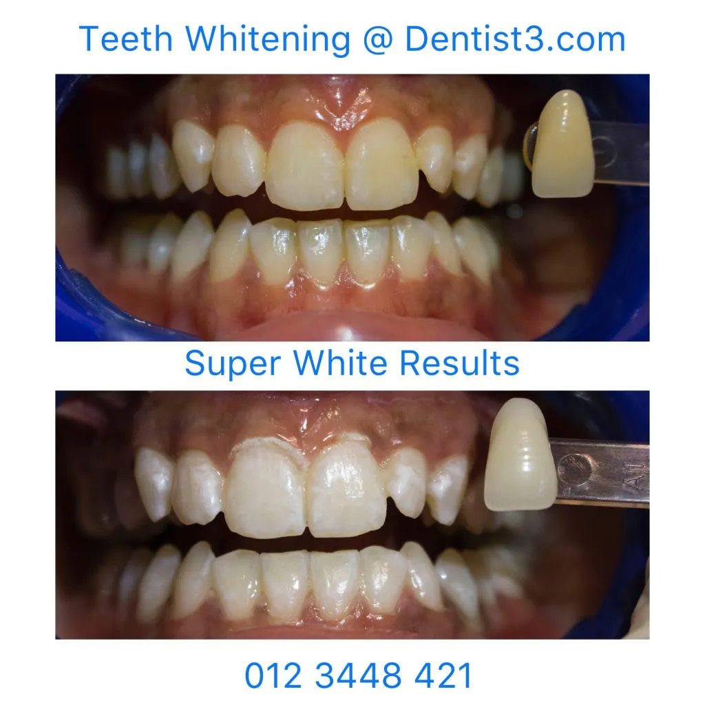 26973 teeth whitening smile