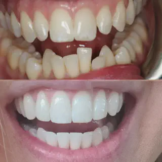 /img/26977-maintaining-white-smile.webp