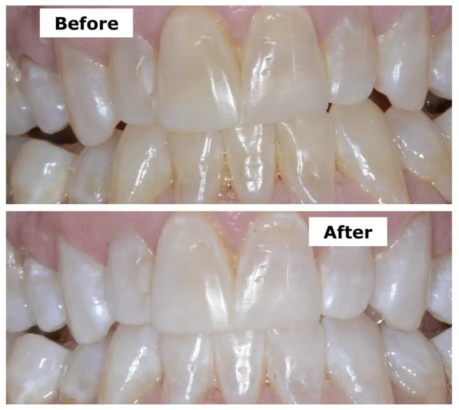 26979 at home teeth whitening kit