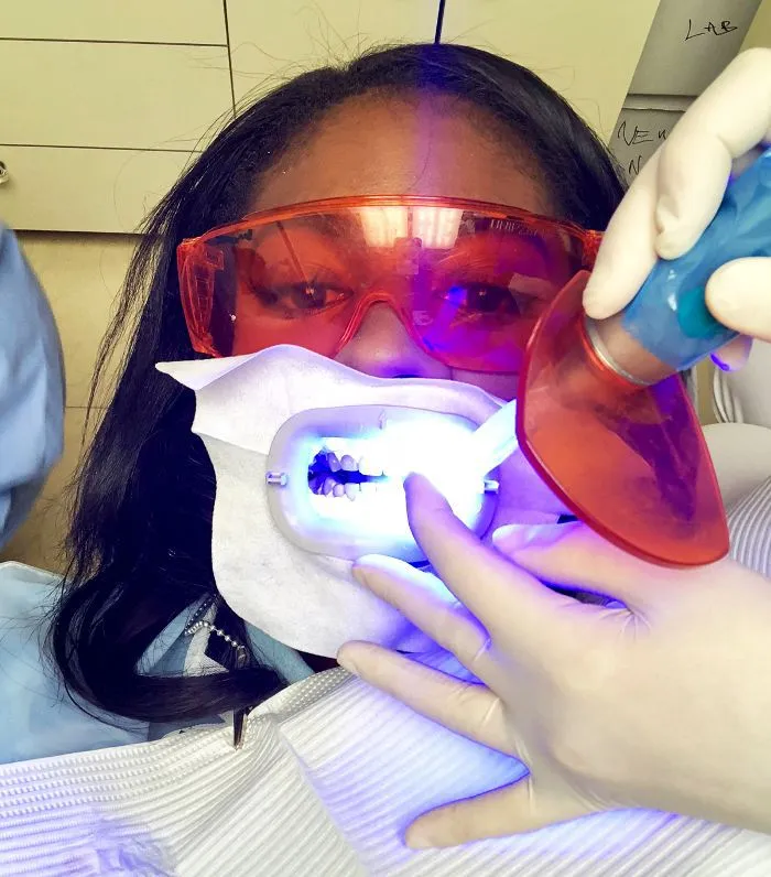 26984 laser teeth whitening indianapolis 6