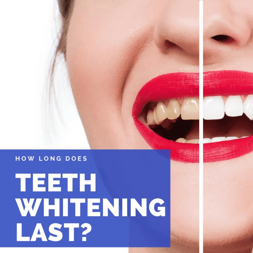 26992 teeth whitening maintenance