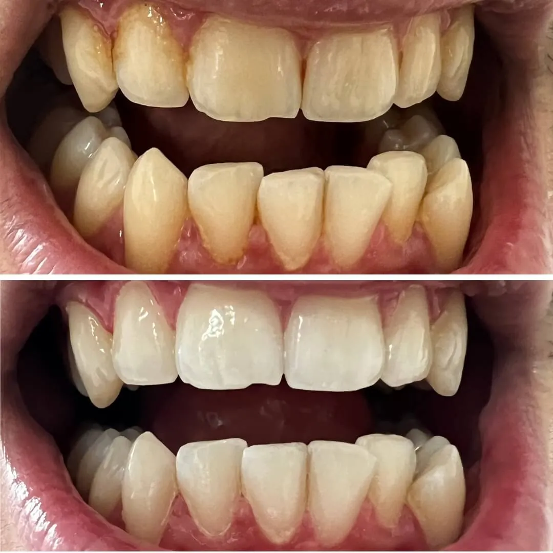 26994 teeth whitening process
