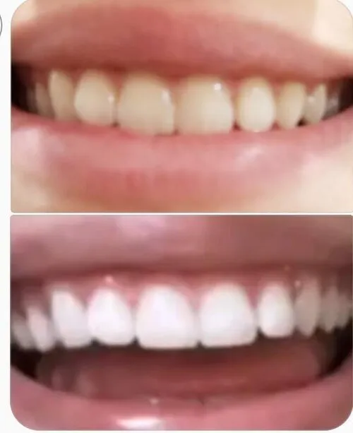 26997 over the counter whitening