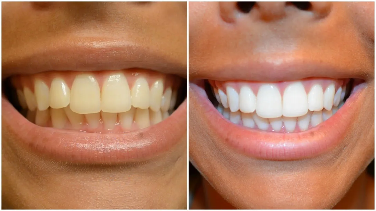 /img/27002-alternatives-to-whitening-strips.webp