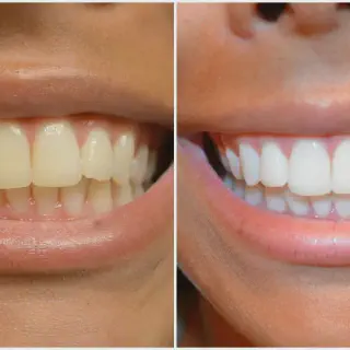 /img/27002-alternatives-to-whitening-strips.webp