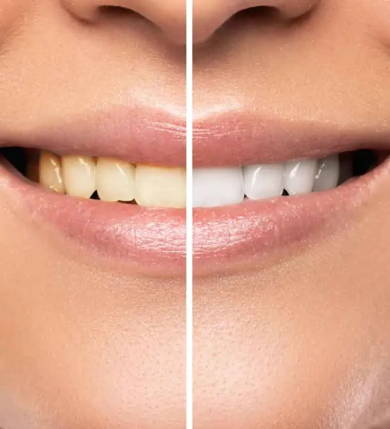 27004 professional teeth whitening toms river nj