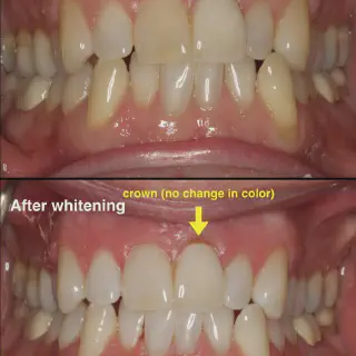 /img/27005-zoom-whitening-houston-tx-confidence.webp