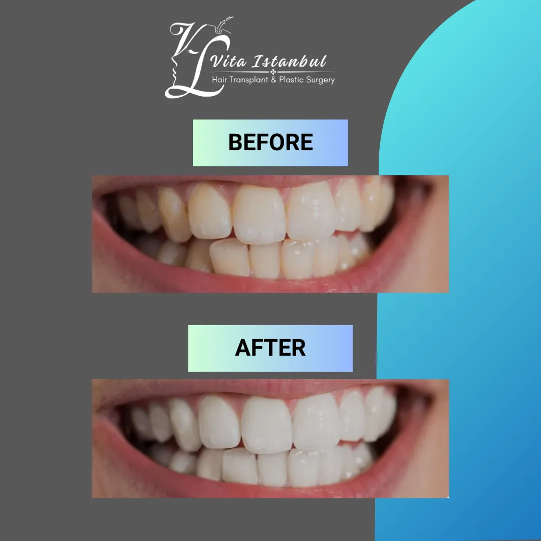 27007 teeth whitening aftercare