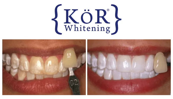 /img/27008-teeth-whitening-klerksdorp-confidence.webp
