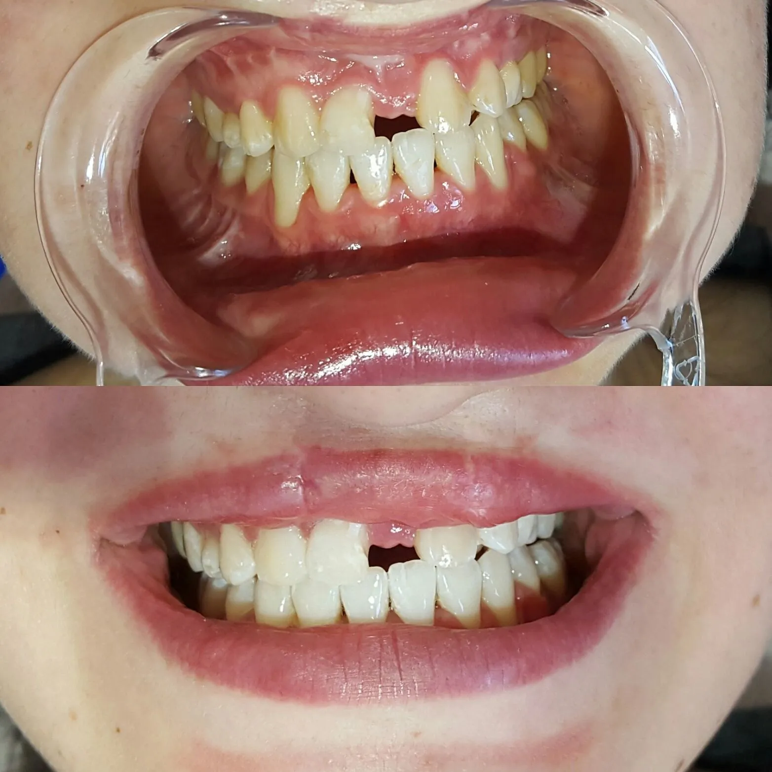 27009 teeth whitening before after