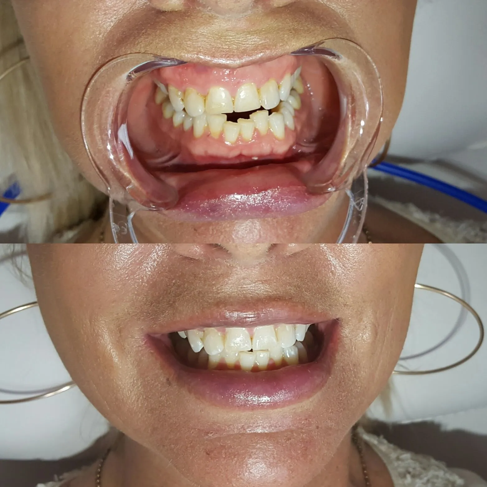 27009 teeth whitening process