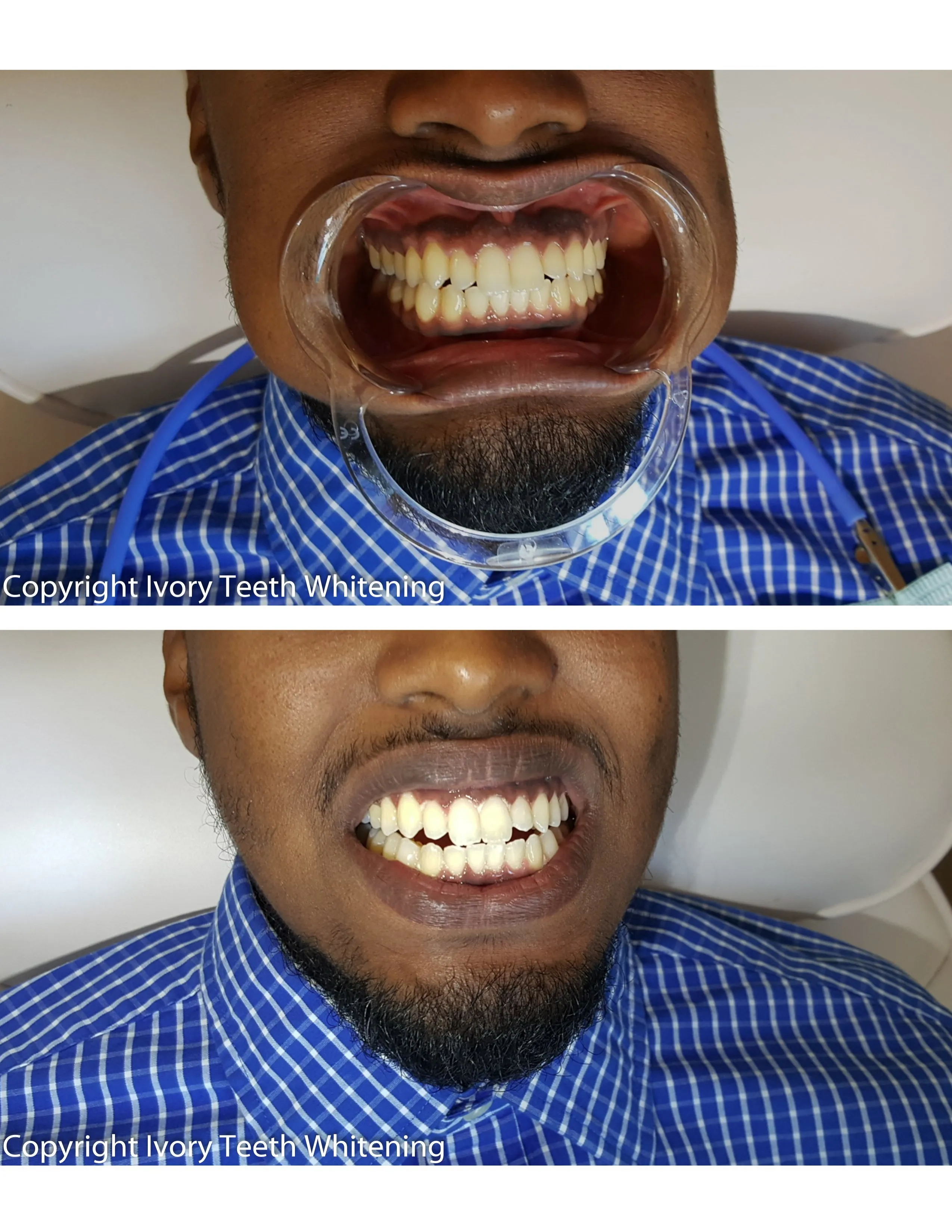 /img/27009-white-smile-maintenance.webp