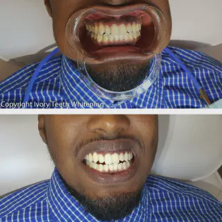 /img/27009-white-smile-maintenance.webp