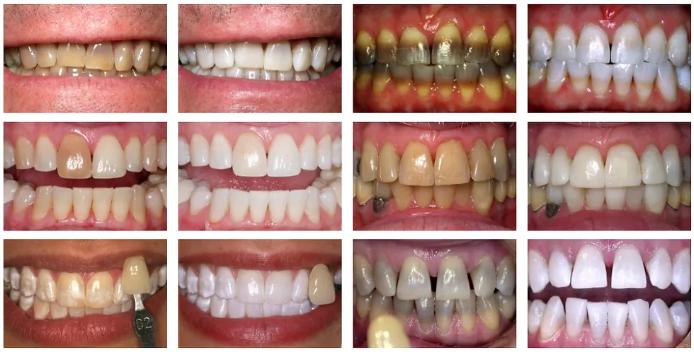 27010 teeth whitening gum alternatives