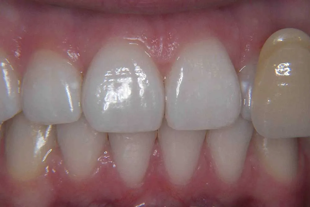 /img/27011-caring-for-bonded-teeth.webp