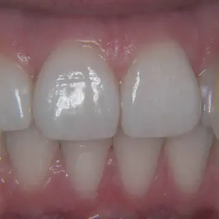 /img/27011-caring-for-bonded-teeth.webp