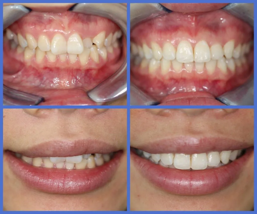 27011 cost of teeth whitening