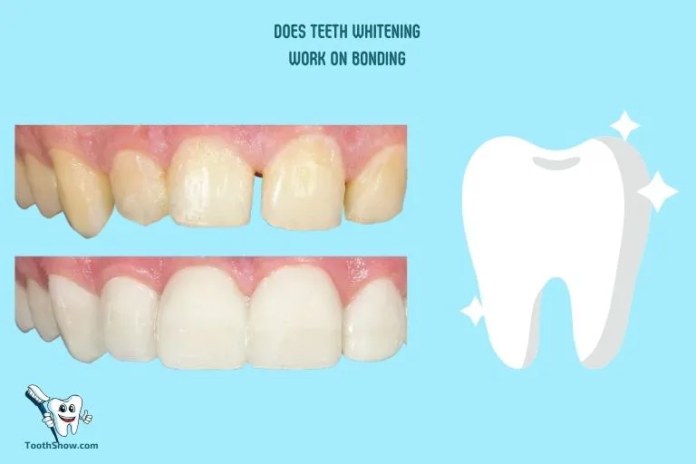 27011 dental bonding procedure