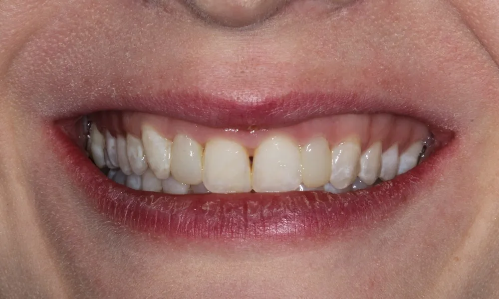 27011 in office teeth whitening