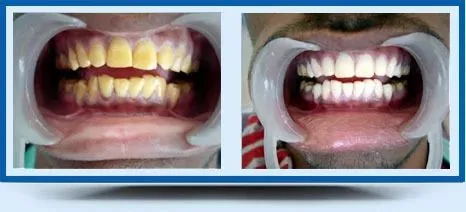 27011 teeth whitening vs bonding