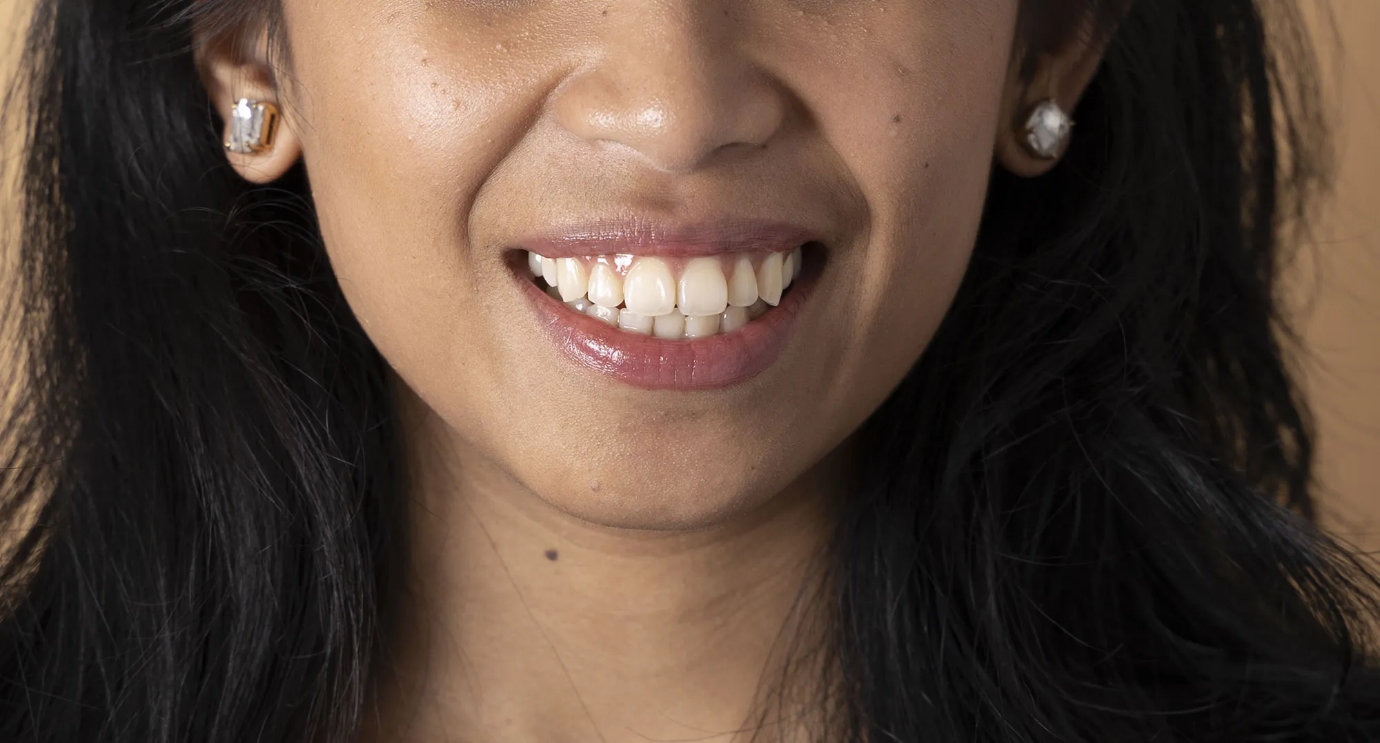 27012 over the counter whitening