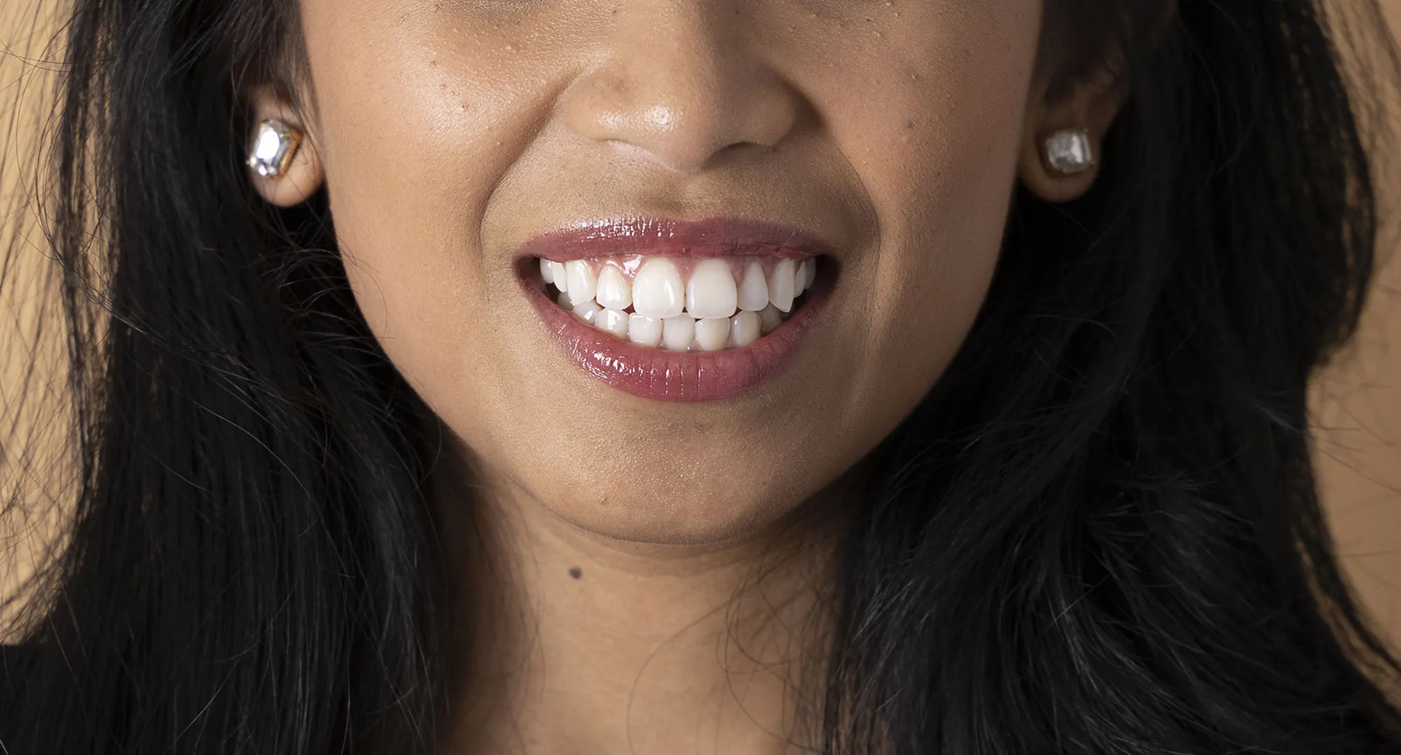 27012 professional teeth whitening