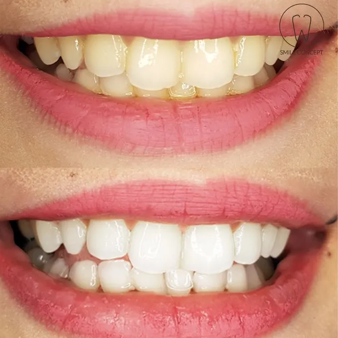 27015 at home teeth whitening kit